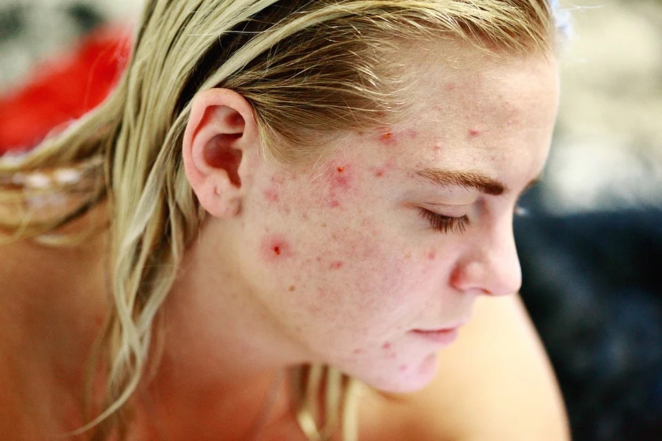 How to deal with your skin for removing acne