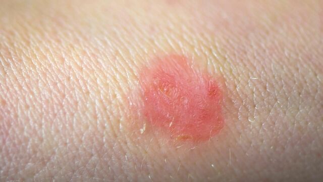 Skin conditions you should know about 01 ringworm 1440x810 display